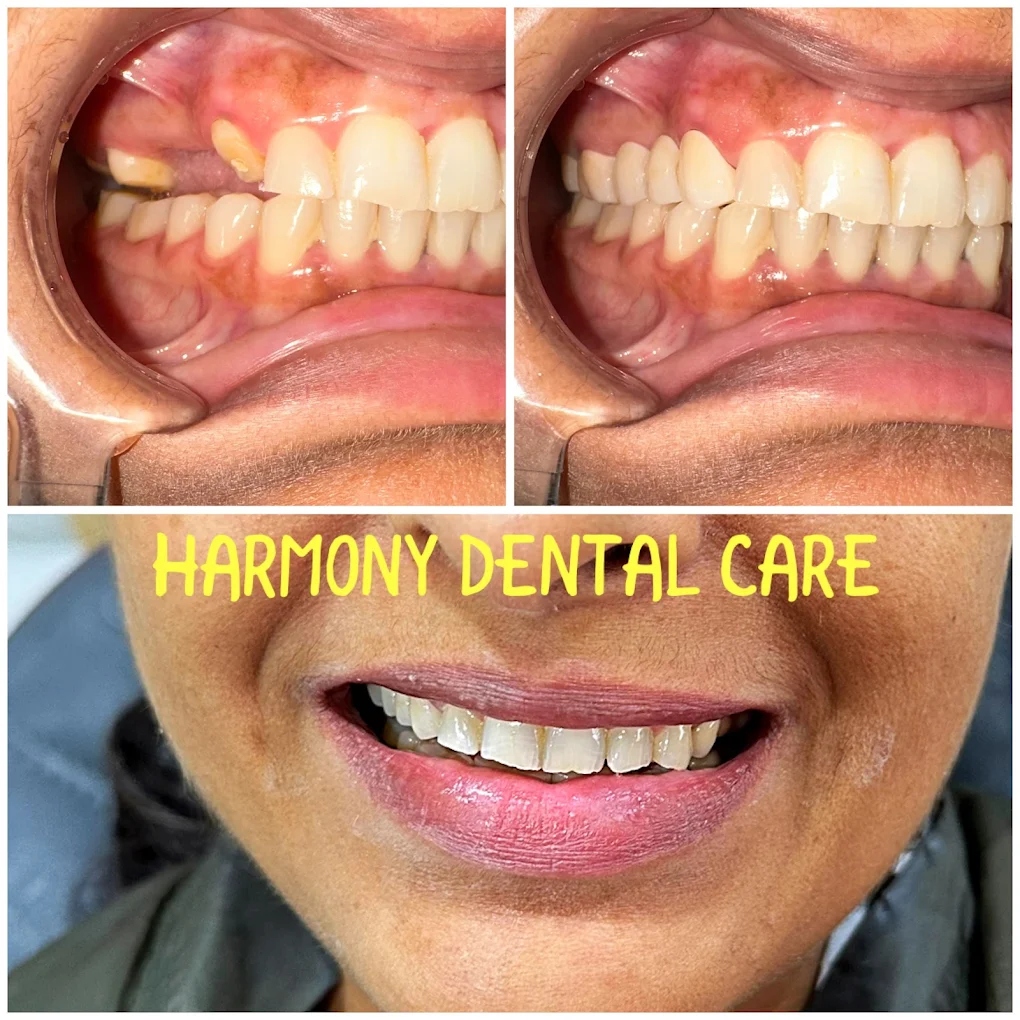 Dental implant and molar crown restoration before and after at Harmony