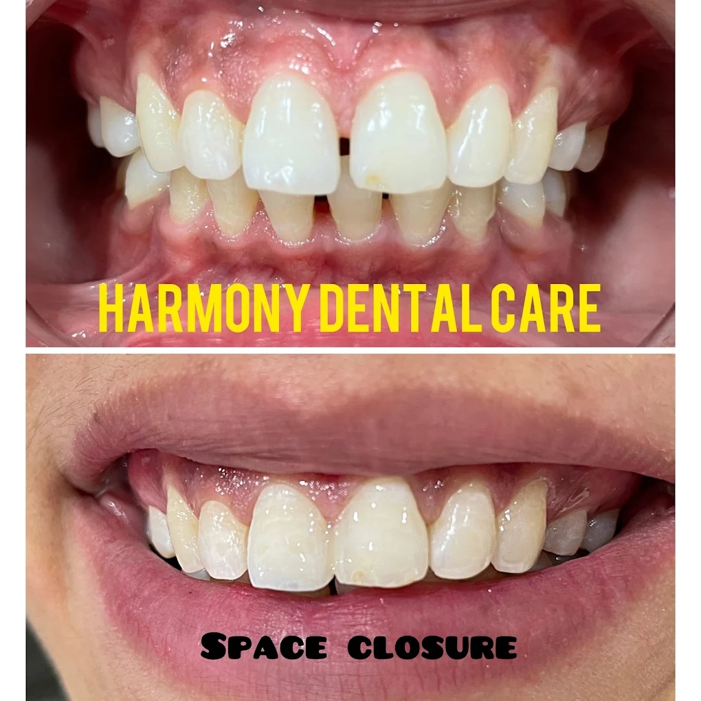 Space Closure cosmetic align before and after dental treatment at Harmony